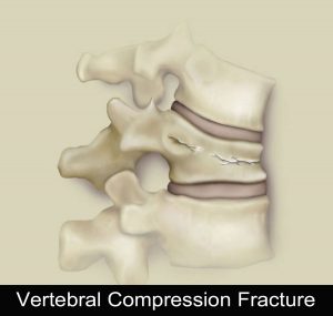 Lumbar Compression Fracture