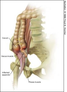 Psoas-Appendix Anatomy
