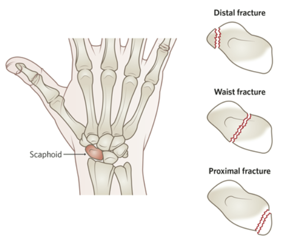 Scaphoid Fracture Detection & Management